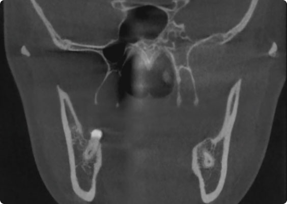 Before cone-beam artifact reduction